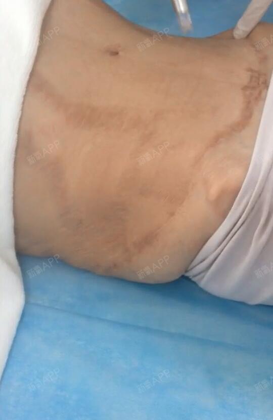 去妊娠纹好不好_效果图_去妊娠纹术后第1天_新氧美容整形