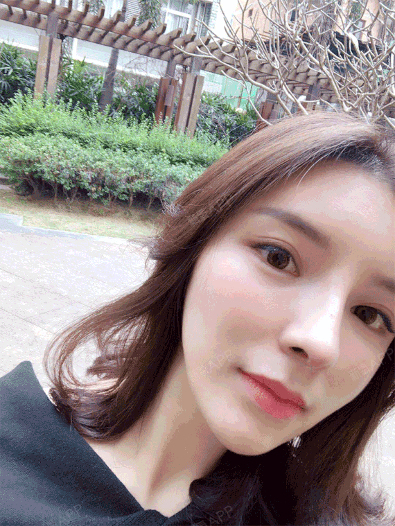 沫离伤花jok鼻综合术后第62天美丽日记_新氧整形