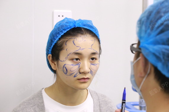 长沙嘉悦莱自体脂肪填充全脸手术当天