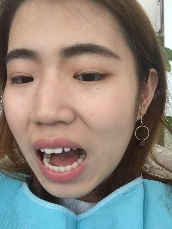 想记录下牙齿矫正的过程,那就写个日记吧.