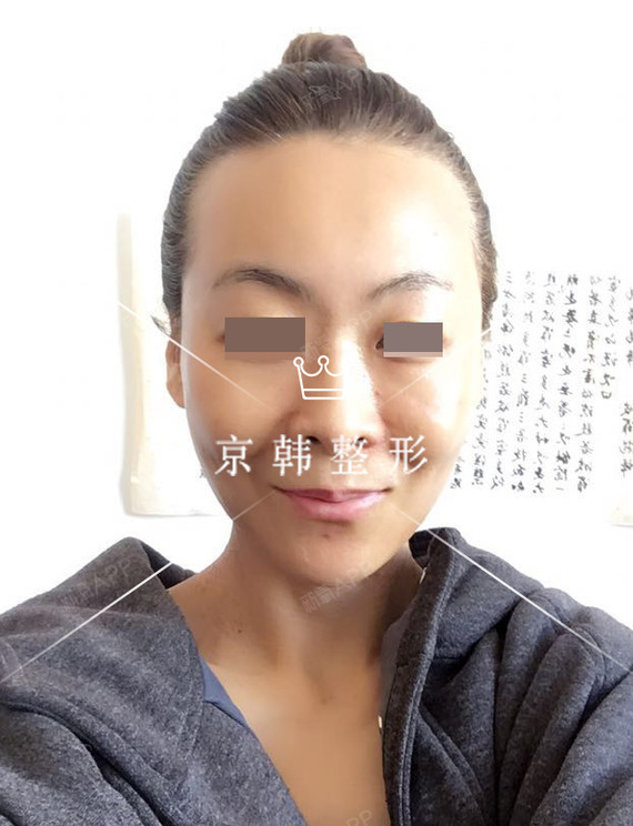 氧气jIE1536自体脂肪全脸填充第21天美丽日记