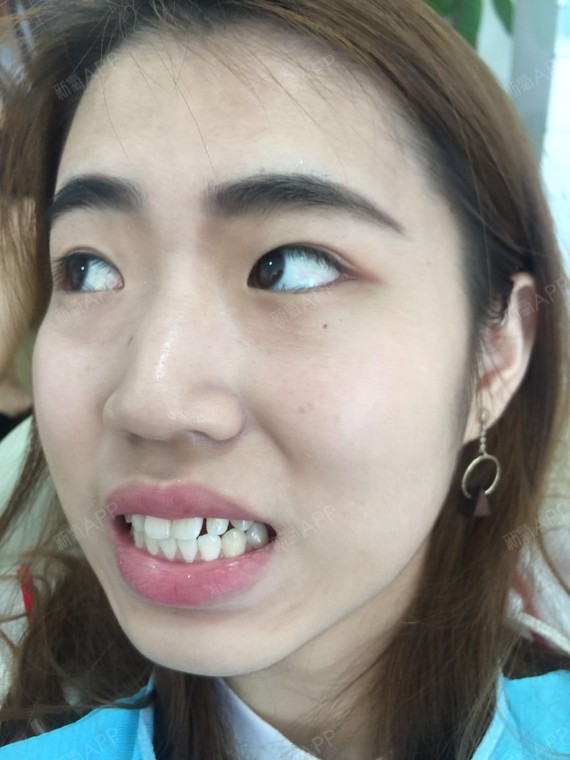 想记录下牙齿矫正的过程,那就写个日记吧.