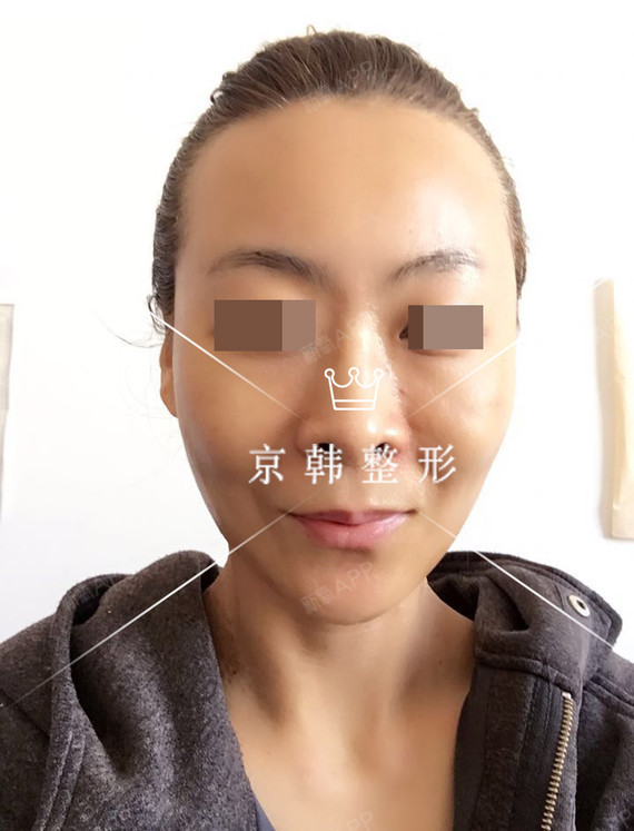 氧气jIE1536自体脂肪全脸填充第21天美丽日记