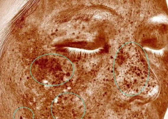 深层斑皮肤检测显示:面颊部及颧部黄褐斑明显,肤色暗沉.