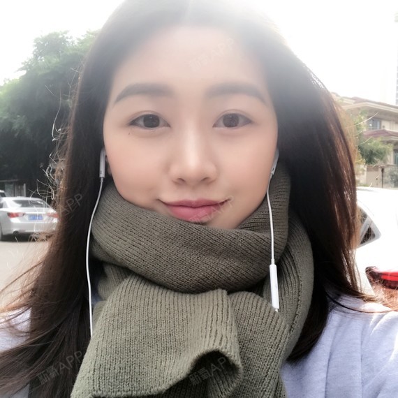 武汉自体脂肪全脸填充好不好_效果图_小小小谢自体脂肪全脸填充术后第