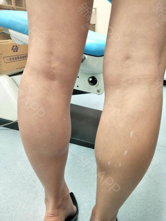 氧气upad75a肉毒素瘦小腿第0天美丽日记