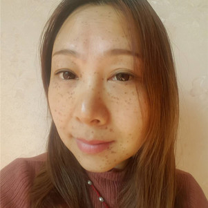 【激光祛斑】大铁祛斑 以色列进口飞顿大q祛雀斑 快速匀净 全层净斑不