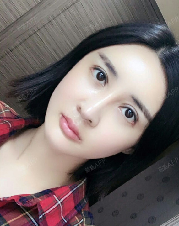 哈喽,宝宝们!这是我注射玻尿酸丰嘟嘟唇的10多天了_圈子-新氧美容整形