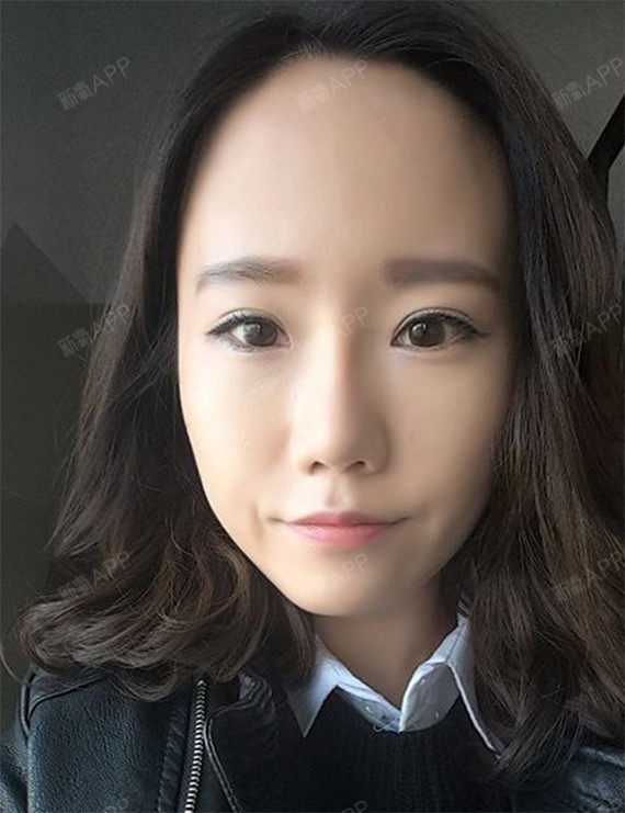 全切双眼皮术后一个月:这个世界上眼睛小的女生真的是_圈子-新氧美容