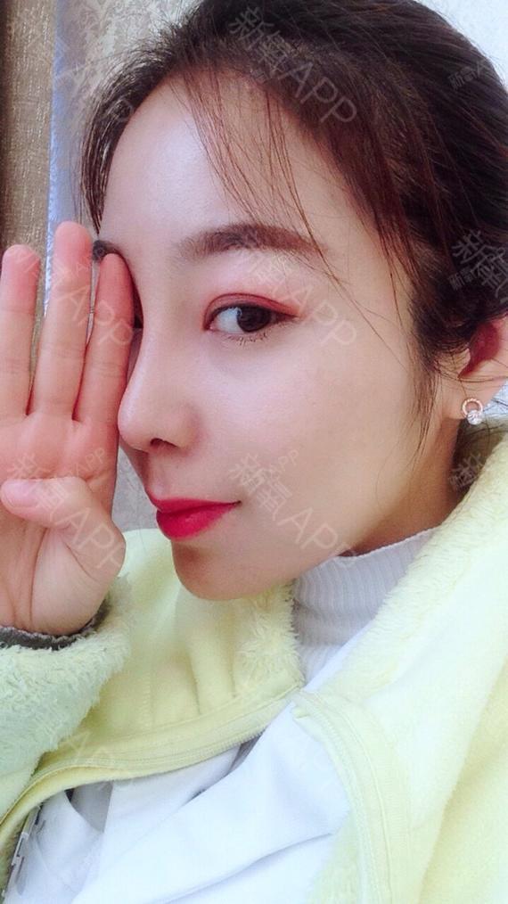 基本上没什么问题了,就是一定要注意保护鼻子不受碰撞和伤害就可以了