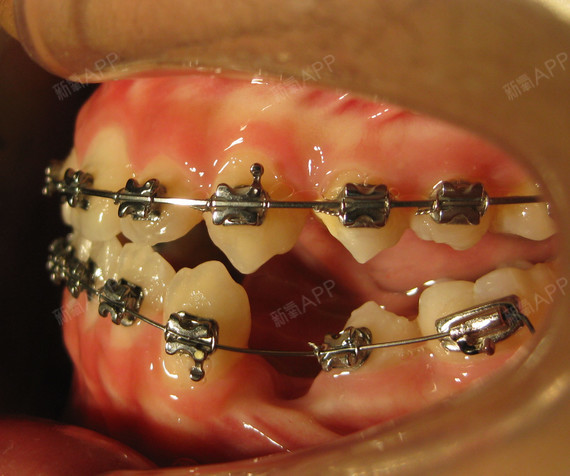 【牙齿美容】金属托槽矫正