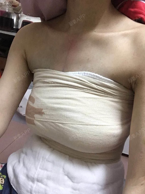 我虽然年龄不大但是自从生完宝宝哺乳过就胸部下垂很严_圈子-新氧美容