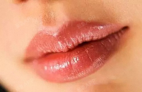 有唇珠的嘴唇,微闭微张时,唇珠非常的明显,两唇之间的弓形弧度