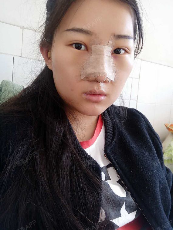 之前鼻子比较塌,鼻梁也不挺,经过朋友的推荐来素美做_圈子-新氧美容