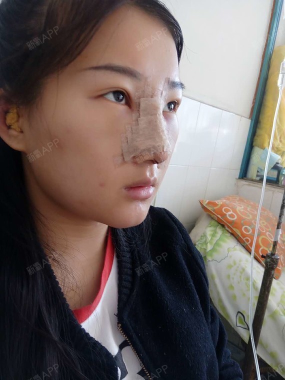 之前鼻子比较塌,鼻梁也不挺,经过朋友的推荐来素美做_圈子-新氧美容
