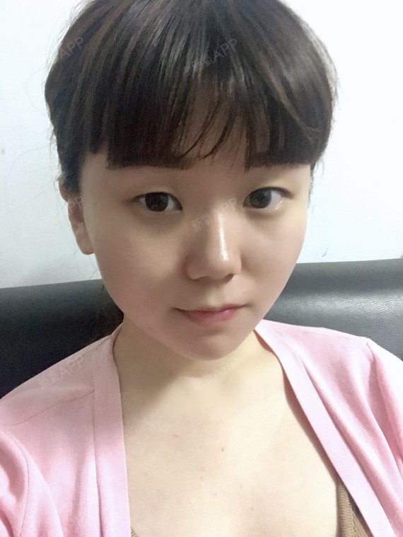 前有朋友在星雅做了双眼皮,术后的效果很好看,我很_圈子-新氧美容整形