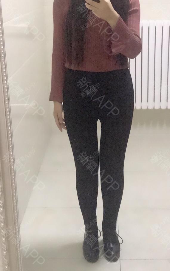 大腿外侧内侧肉都没了,真的瘦了很多,腿型矫正后腿直了很多.