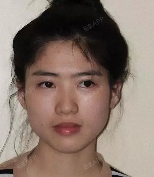 我是属于下颌角特突出的那种,正面看过去要是下巴再短_圈子-新氧美容
