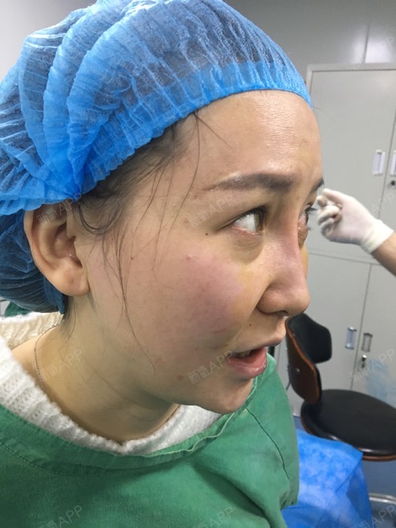 静曼茹埋线隆鼻第0天美丽日记