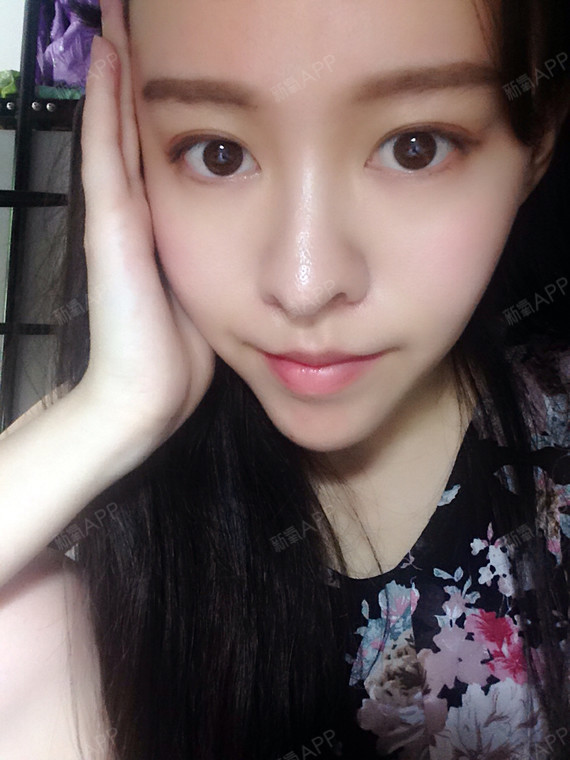 今天就给大家看看我术后恢复的高清素颜照哦.哈哈哈哈,第一