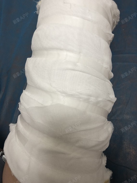 吸脂瘦大腿好不好_效果图_晚晴wanting吸脂瘦大腿术后第0天_新氧美容