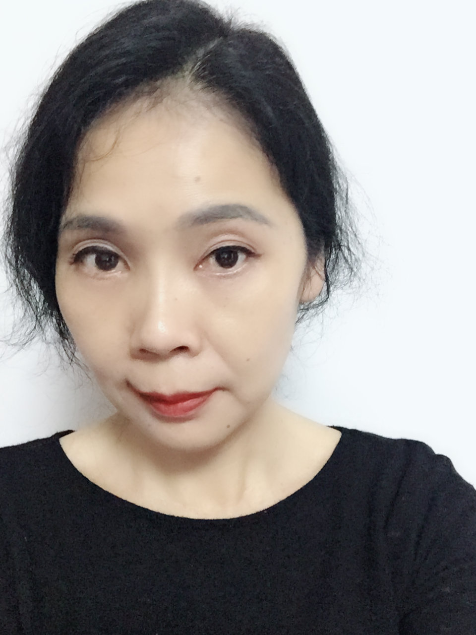 【提眉 祛眼袋术后第109天】效果现在是越来越好._圈子-新氧美容整形