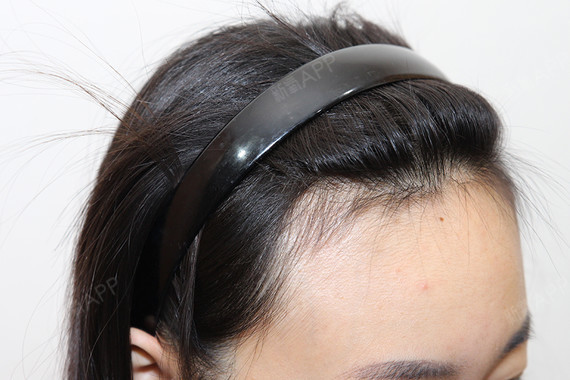 因为额头太高,都不敢扎这样的_圈子-新氧美容整形