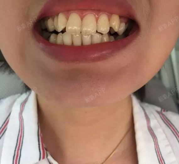 因天生下排牙齿缺失两颗,再加上下面有一颗牙