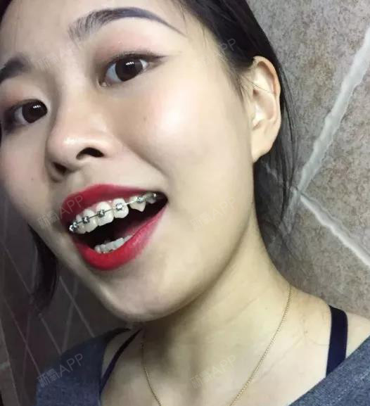 去年中旬正式成为小钢牙.因天生下排牙齿缺_圈子-新氧美容整形