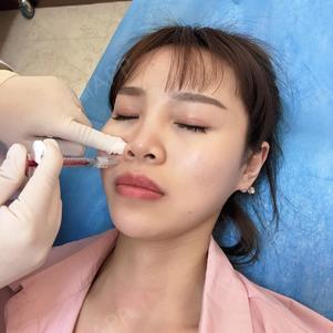 北京玻尿酸丰鼻基底好不好_效果图_氧气cl15250玻尿酸丰鼻基底术后第0