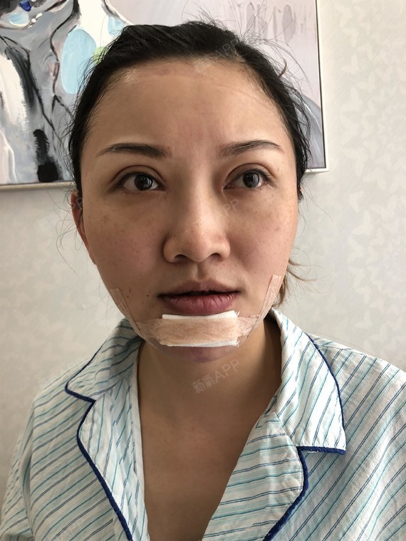 北京硅胶垫下巴好不好_效果图_有下巴的小天使硅胶垫下巴术后第0天