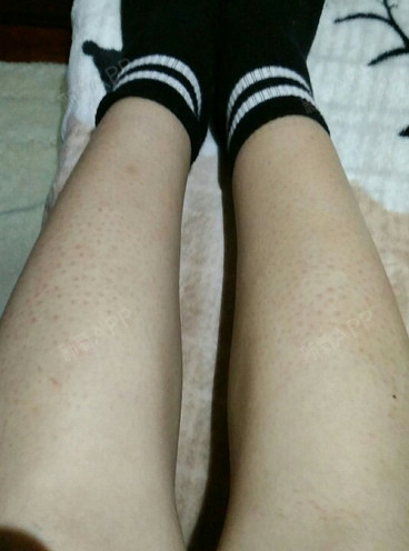 刚开始什么都不知道,所以经常拔腿毛,刮腿毛,尤其是_圈子-新氧美容