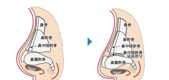 答案是:用软骨把不够长的鼻中隔软骨延长,把鼻尖向下延伸,或者