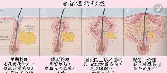 但是对操作手法器具都有要求,有组织液的痘痘挤不好就出现了这几种