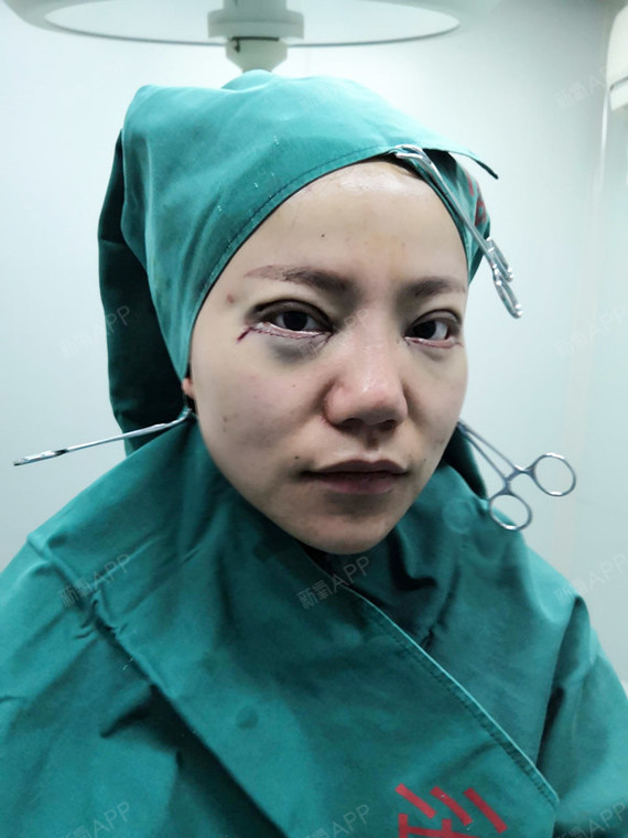 外切去眼袋好不好_效果图_知道我不仅仅是爱你外切去眼袋术后第1天