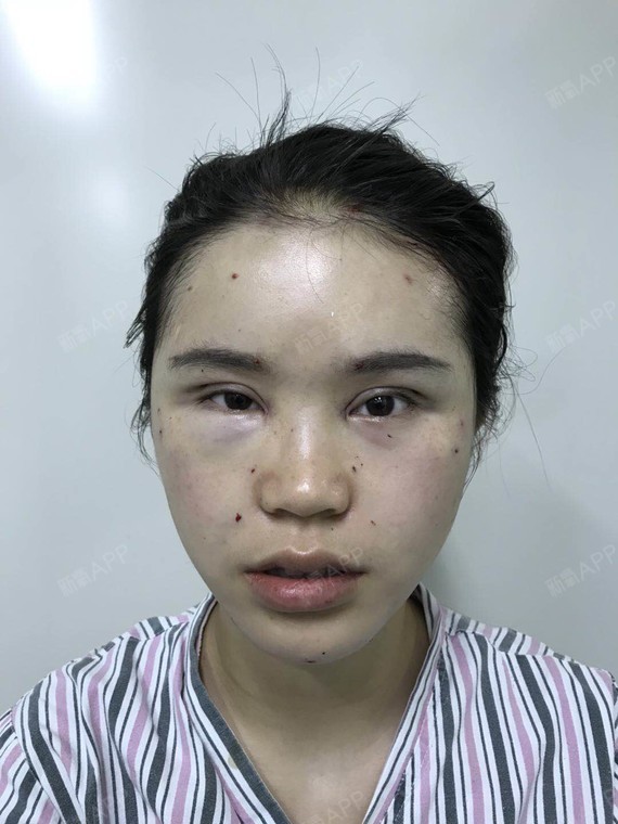 新氧- 风一般女子 | 眼部 | 开眼角 | 双眼皮 | 开内眼角 | 自体脂肪