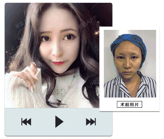 杨女士park法周安专利双眼皮案例前后对比~心动的_圈子-新氧美容整形