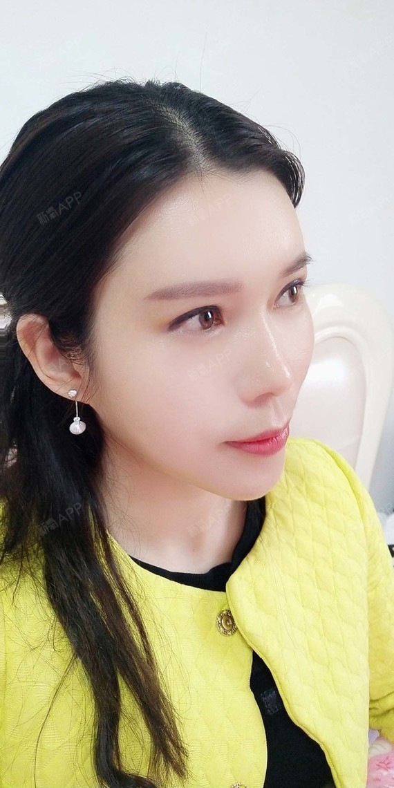 全给朕滚自体脂肪丰面颊第65天美丽日记