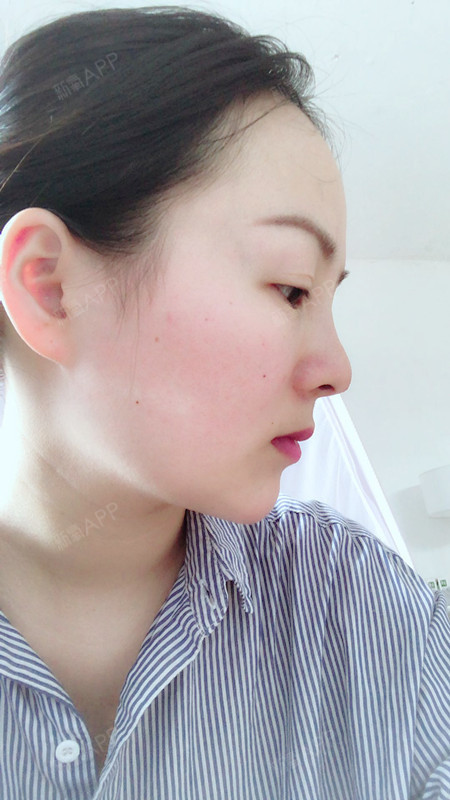 昨天做了一个线雕隆鼻,做完了就马上赶火车回江苏真的_圈子-新氧美容