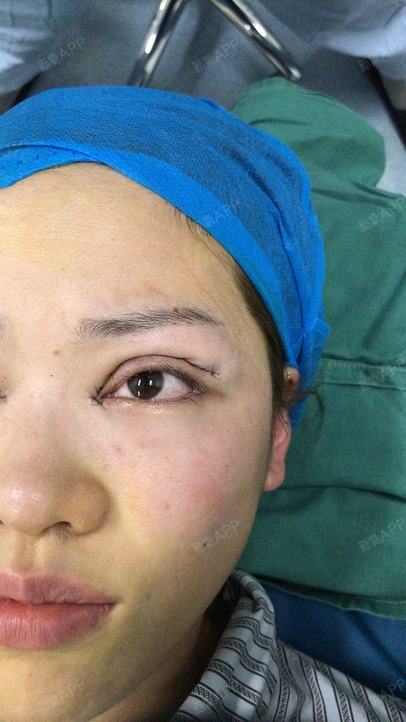 开眼角,就是在眼角处切道口那么简单吗?