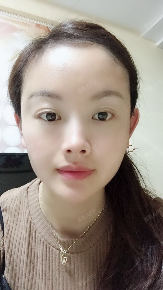 自身脂肪就保留的很好,做完一次到现在都很稳定,真的要谢谢刘耀美医生