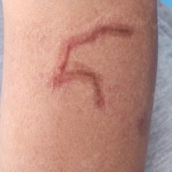 美疤克疤痕治疗术后0天