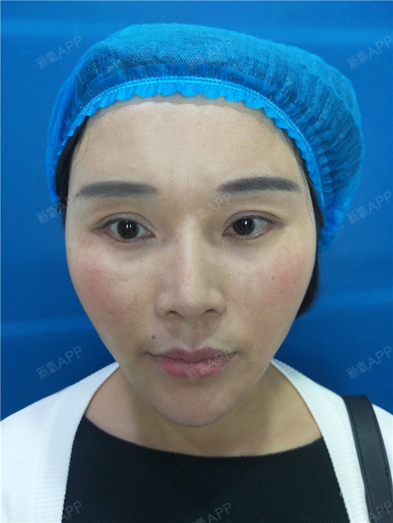 玻尿酸丰面颊好不好_效果图_氧气moza6ca玻尿酸丰面颊术后第1天_新氧