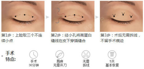 埋线双眼皮手术原理分析