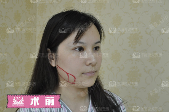 #俊俏小脸如何打造#脸型的改变对每一个爱美