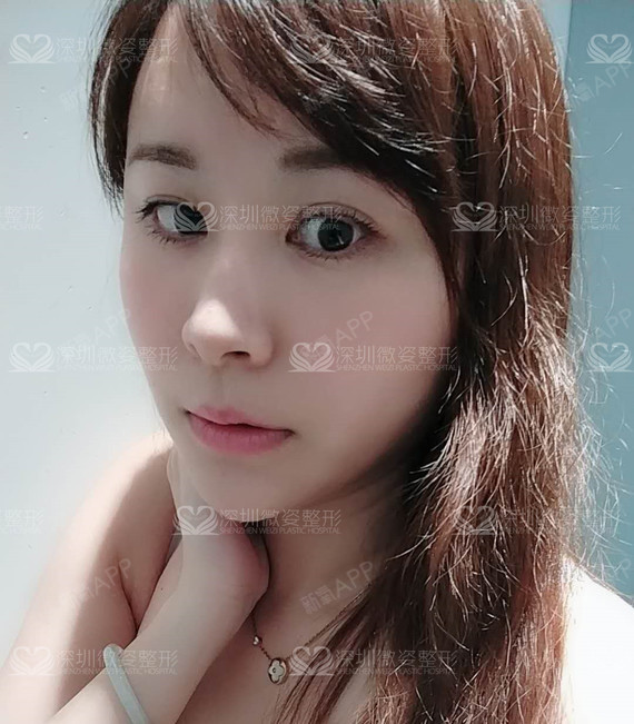 #俊俏小脸如何打造#脸型的改变对每一个爱美