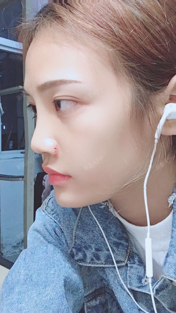 南昌耳软骨复合隆鼻好不好_效果图_小舒琪耳软骨复合隆鼻术后第7天