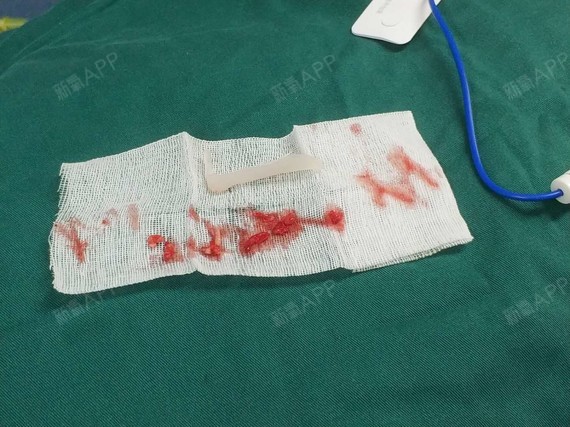 这是取出的l型硅胶假体.