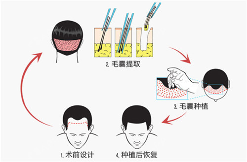 毛发种植有效图片