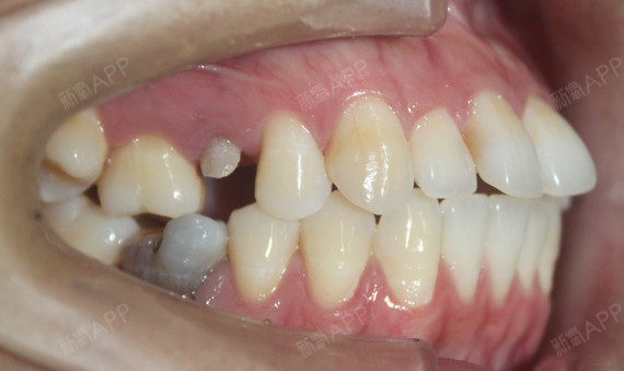 牙列拥挤不齐, 残根残冠,近中倾斜,下颌缺失一颗切牙,上下中线不齐